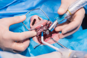 guided implant surgery