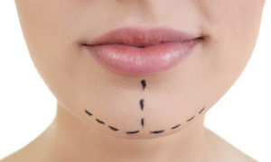 chin plastic surgery
