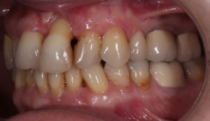 early periodontitis can be reversed