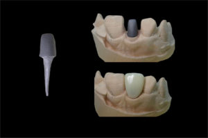dental post and core problem