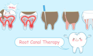 Root canal treatment is necessary for severe tooth infections.
